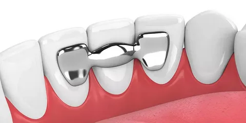 Exploring the Cost of Dental Bridges Without Insurance Coverage